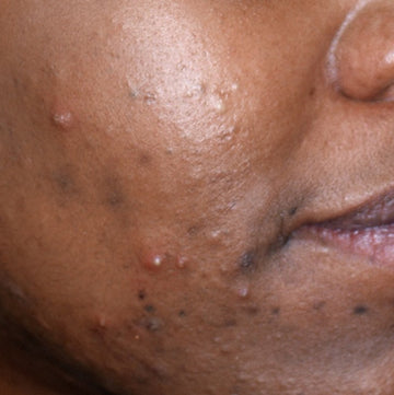 Ingredient Spotlight: Milk Thistle (Silymarin) & Acne