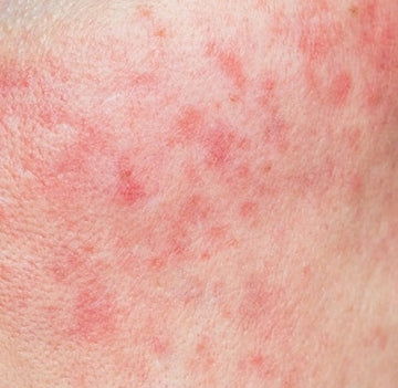 Managing Rosacea: Symptoms, Treatments, and Skincare Tips