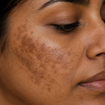 Why melasma keeps coming back?  What to do about it - Causes, Treatments and Prevention.