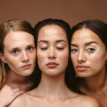 Close up of three women with acne and melasma conditions