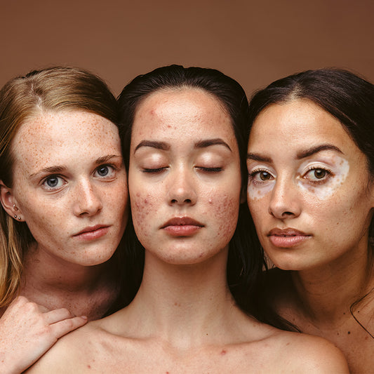 Close up of three women with acne and melasma conditions
