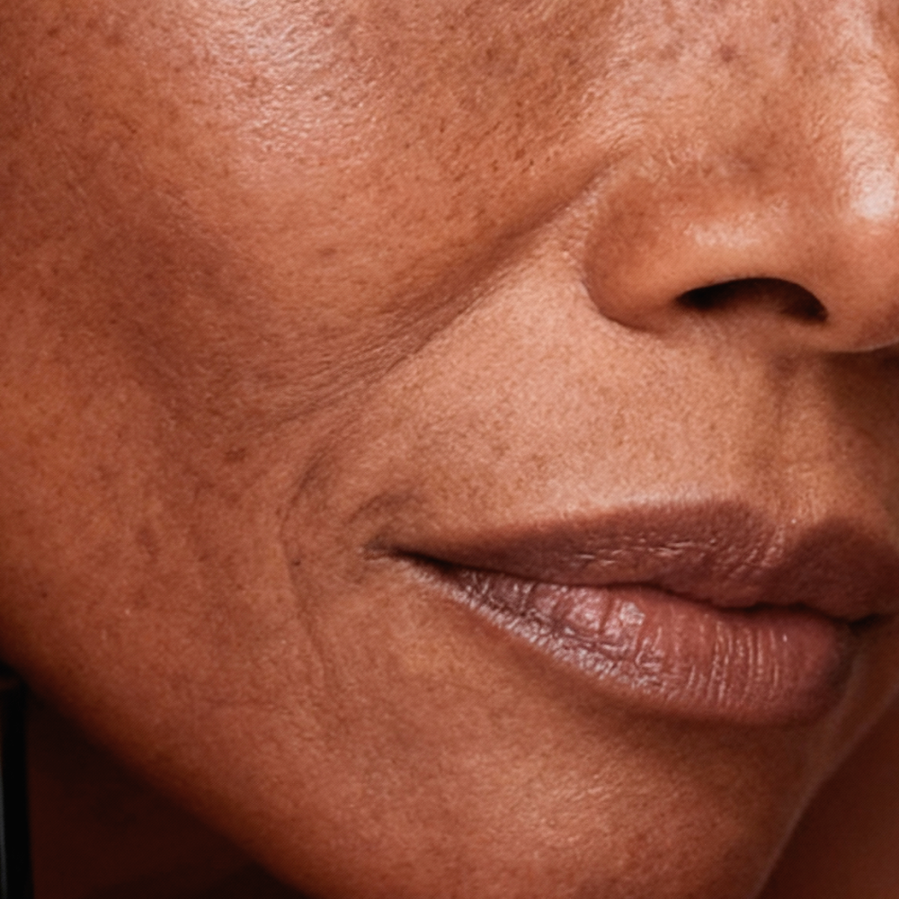 Hyperpigmentation